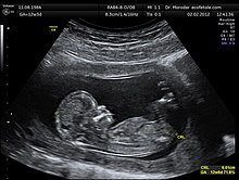 220px-CRL_Crown_rump_length_12_weeks_ecografia_Dr._Wolfgang_Moroder.jpg